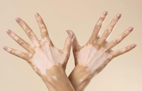 mulher-jovem-mostrando-partes-da-pele-com-vitiligo