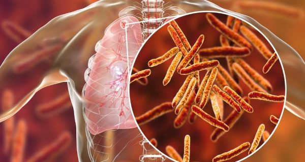 tuberculose credito iStock