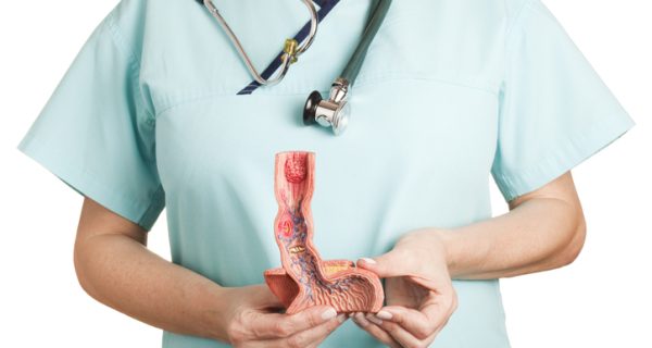 A nurse holding an anatomical model of human oesophagus.  The model shows the following illnesses: reflux oesophagitis, ulcus, Barrett’s Ulcer, Oesophageal carcinoma, Oesophageal varices and hiatal hernia. White background.