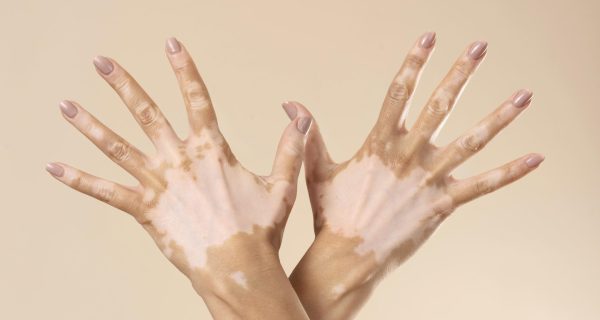 mulher-jovem-mostrando-partes-da-pele-com-vitiligo
